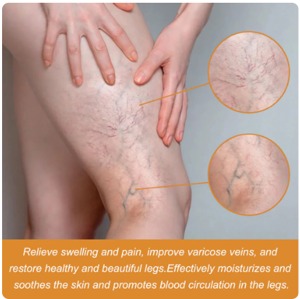 Varicose Veins Healing Spray