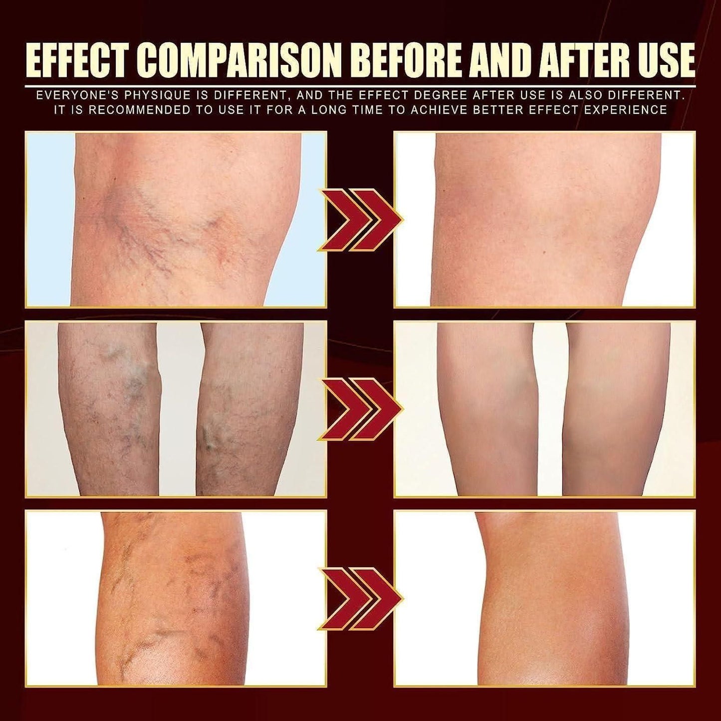 Varicose Veins Healing Spray