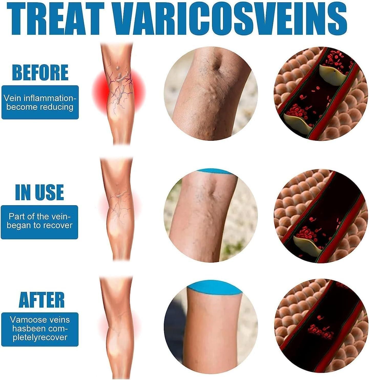 Varicose Veins Healing Spray