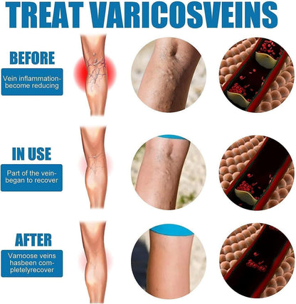 Varicose Veins Healing Spray