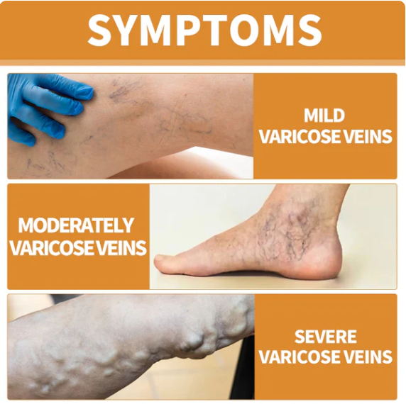 Varicose Veins Healing Spray