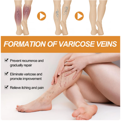Varicose Veins Healing Spray