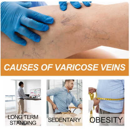Varicose Veins Healing Spray